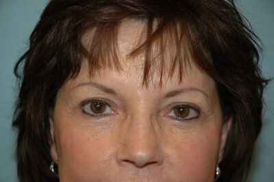 Blepharoplasty & Browlift