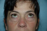 Blepharoplasty & Browlift