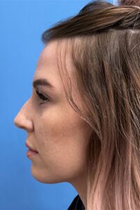 Rhinoplasty