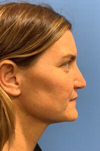 Rhinoplasty