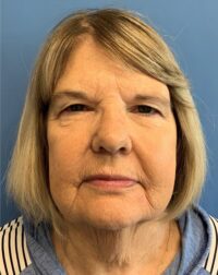 Blepharoplasty & Browlift