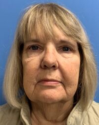 Blepharoplasty & Browlift