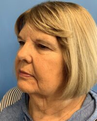 Blepharoplasty & Browlift