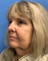 Blepharoplasty & Browlift