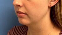 Chin Augmentation