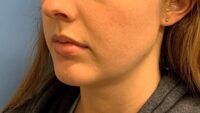 Chin Augmentation