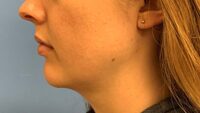 Chin Augmentation