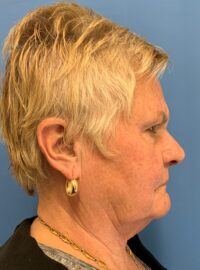 Blepharoplasty & Browlift