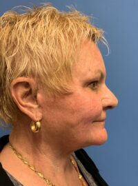 Blepharoplasty & Browlift