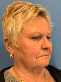 Blepharoplasty & Browlift