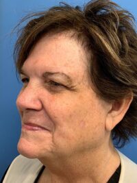 Blepharoplasty & Browlift