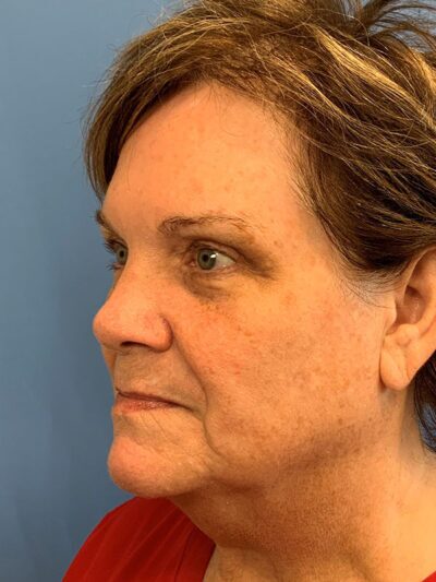 Blepharoplasty & Browlift