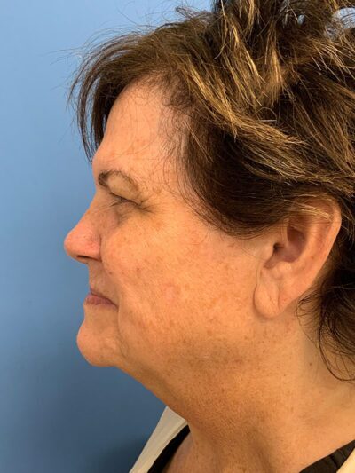 Blepharoplasty & Browlift