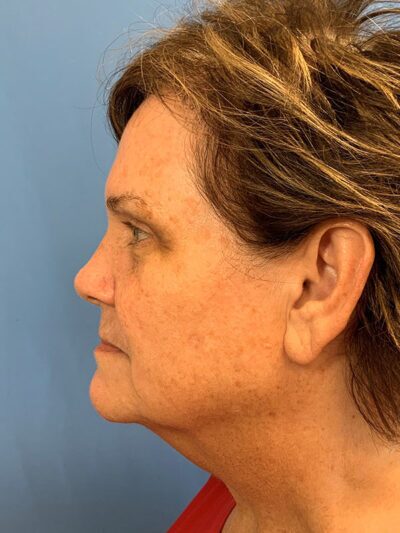 Blepharoplasty & Browlift