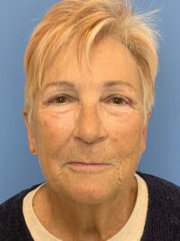 Blepharoplasty & Browlift