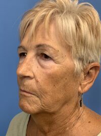 Blepharoplasty & Browlift