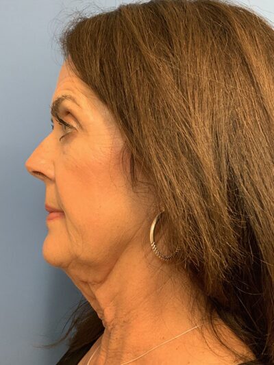 Blepharoplasty & Browlift