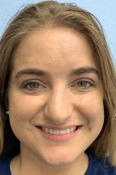 Rhinoplasty Case 474 Before Photo Rhinoplasty