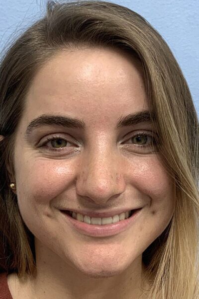 Rhinoplasty Case 474 After Photo Rhinoplasty