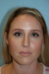Rhinoplasty