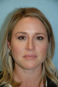 Rhinoplasty
