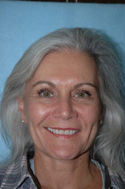 Face & Neck Lift Case 155 After Photo Face & Neck Lift