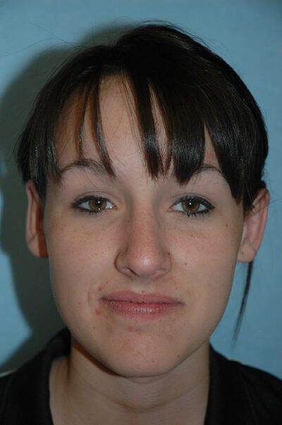 Rhinoplasty Case 241 After Photo Rhinoplasty