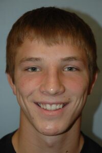 Rhinoplasty