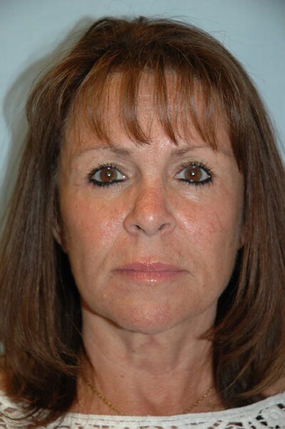 Face & Neck Lift Case 154 After Photo Face & Neck Lift