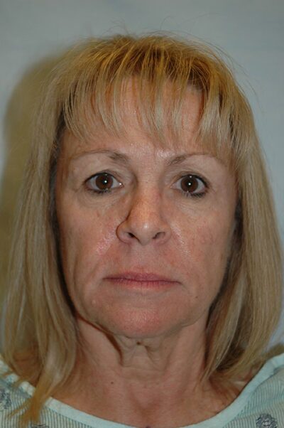 Face & Neck Lift Case 154 Before Photo Face & Neck Lift