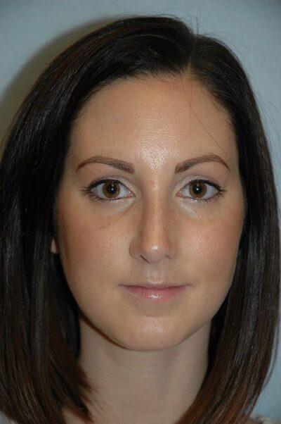 Rhinoplasty Case 232 After Photo Rhinoplasty