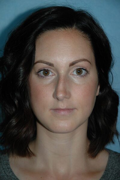 Rhinoplasty Case 232 Before Photo Rhinoplasty