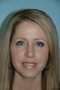 Rhinoplasty