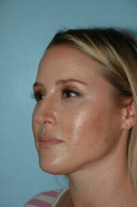 Rhinoplasty