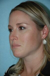 Rhinoplasty