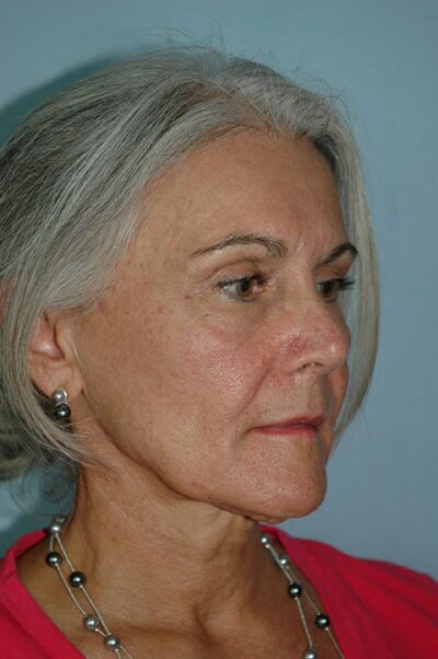 Face & Neck Lift Case 155 Before Photo Face & Neck Lift