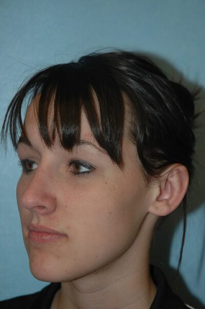 Rhinoplasty Case 241 After Photo Rhinoplasty