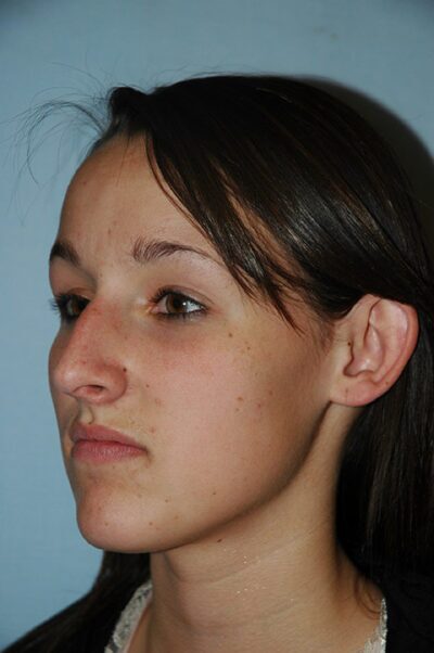 Rhinoplasty Case 241 Before Photo Rhinoplasty