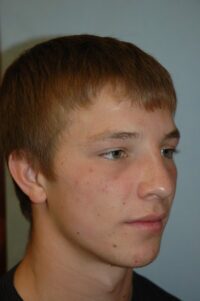Rhinoplasty