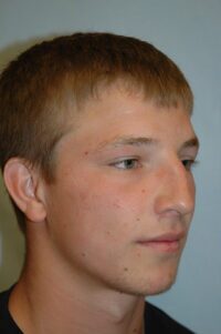 Rhinoplasty