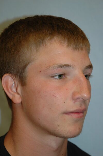 Rhinoplasty Case 235 Before Photo Rhinoplasty