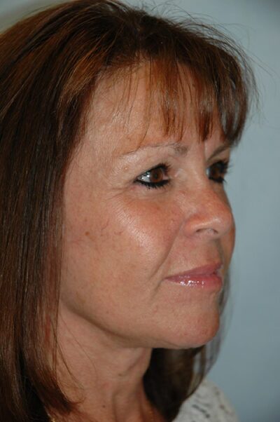 Face & Neck Lift Case 154 After Photo Face & Neck Lift