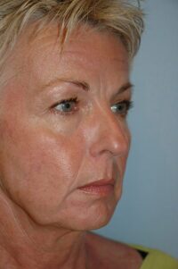 Face & Neck Lift