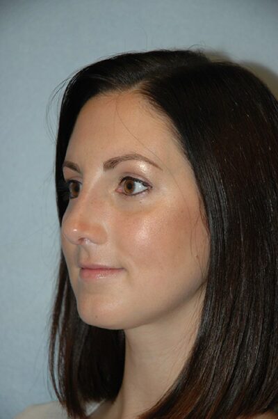 Rhinoplasty Case 232 After Photo Rhinoplasty