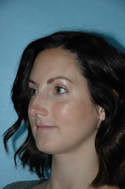 Rhinoplasty Case 232 Before Photo Rhinoplasty