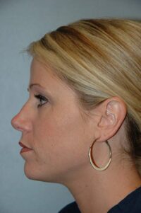 Rhinoplasty