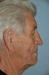 Rhinoplasty