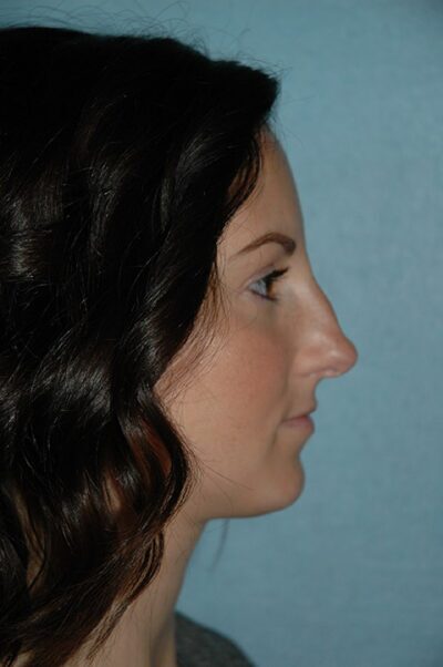 Rhinoplasty Case 232 Before Photo Rhinoplasty