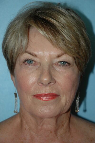 Face & Neck Lift Case 156 Before Photo Face & Neck Lift