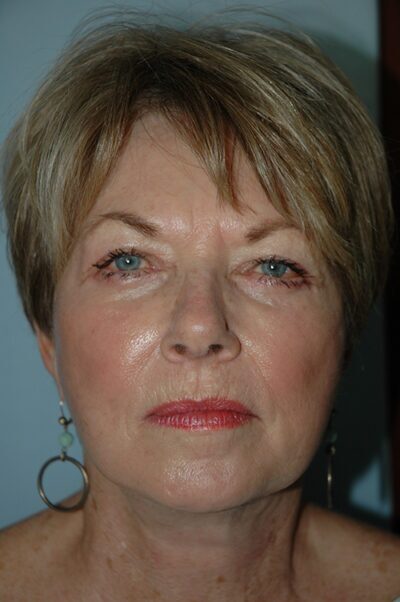 Face & Neck Lift Case 156 After Photo Face & Neck Lift